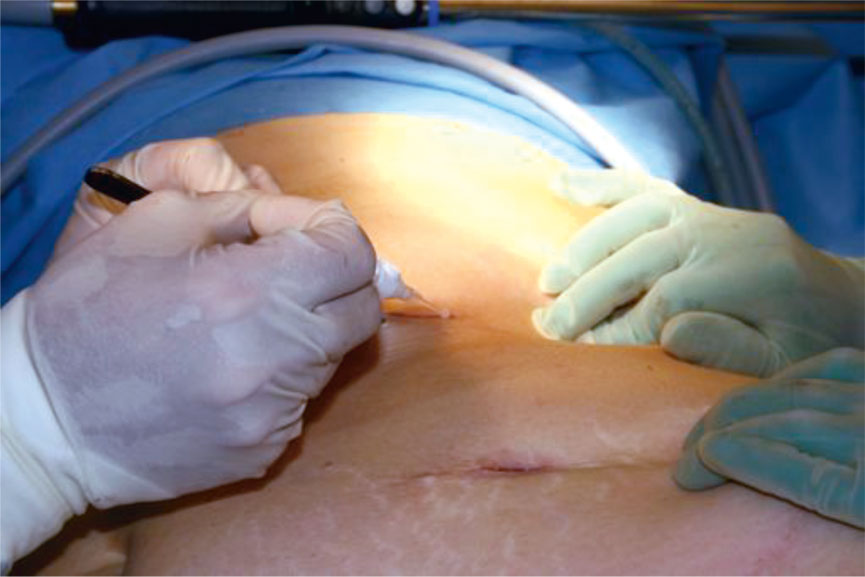 Figur 2. Applisering av Liquiband Laparo-scopic i laparotomi-kanal ved laparoskopisk, hånd-assistert living donor nefrectomi.